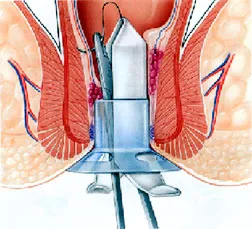 Harmonic Scalpel