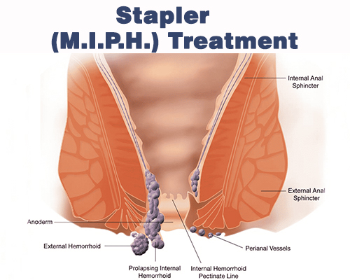 Stapler MIPH Treatment